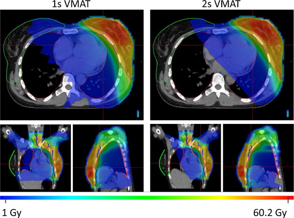 Vmat Solar Volumetric Modulated Arc Therapy (VMAT) – Dr. Melchor Vázquez Uc